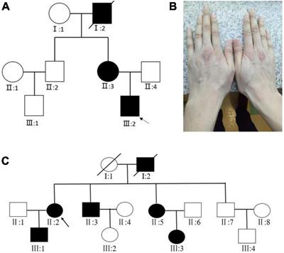 Novel and recurrent FBN1 mutations causing Marfan syndrome in two Chinese families